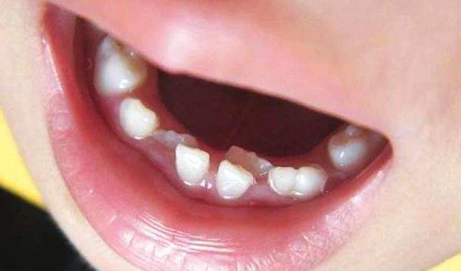 乳牙期干预是第一步,而替牙期和恒牙早期也是牙齿矫正的黄金时期,家长