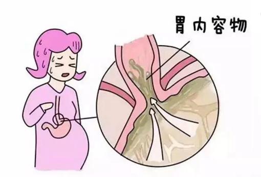 产妇的胃贲门括.jpg